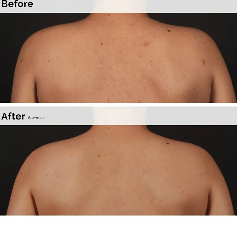 The Ordinary Salicylic Acid 0.5% Body Serum